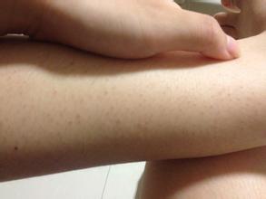 深圳肤康皮毛囊
炎