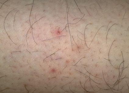 毛囊炎的出现有什么危害